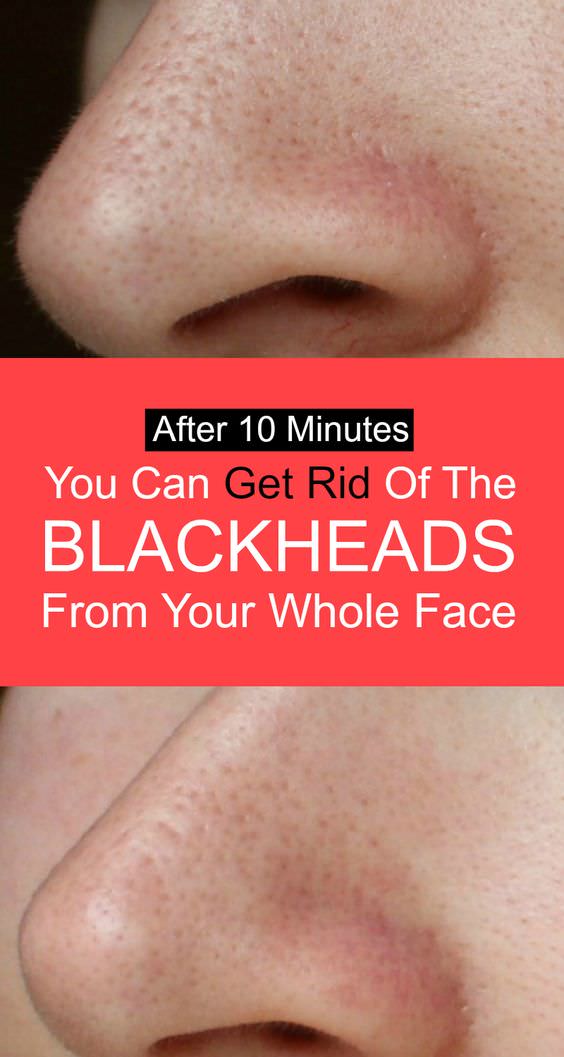 Apply This For 10 Minutes And Get Rid Of Blackheads From Your Whole