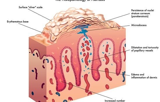 Treating Psoriasis