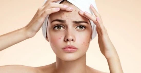 Acne and pimple free skin