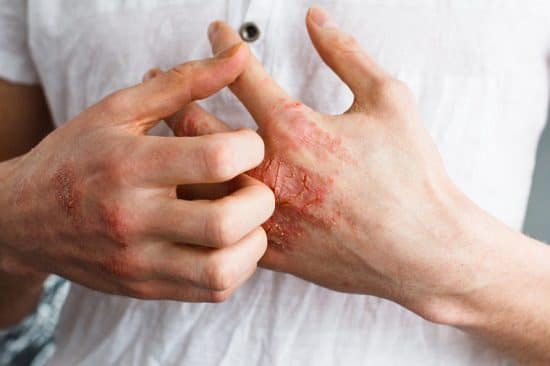 Controls Psoriasis & Atopic Eczema