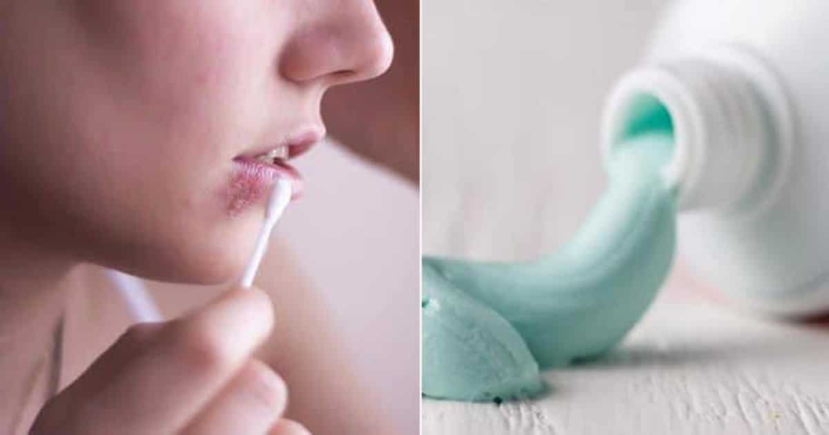 Toothpaste Get Rid Of Cold Sores