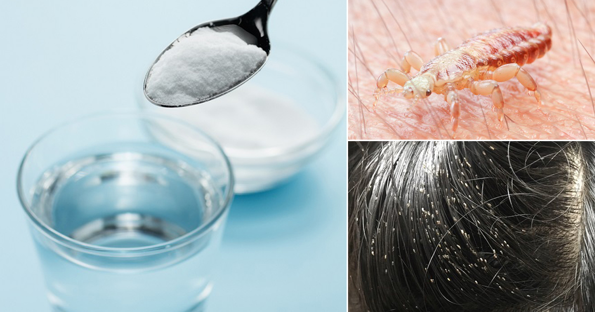 Does Salt Water Kill Lice How to Get Rid of Lice ⋆ Bright Stuffs