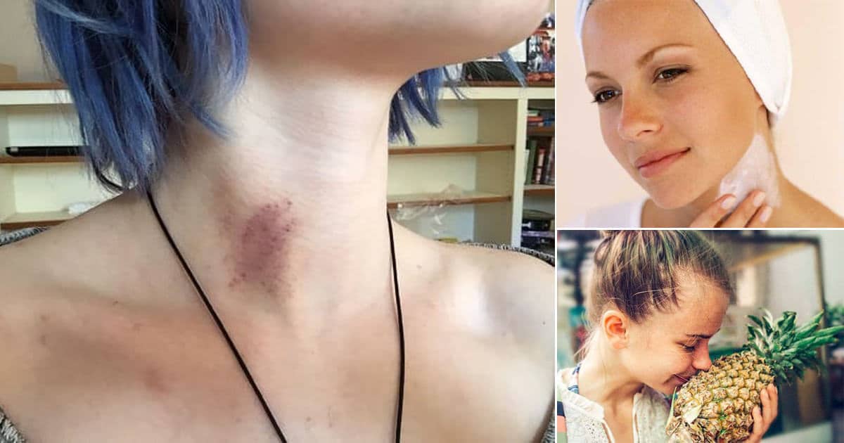 How To Remove A Hickey Types How To Get Rid More Bright Stuffs