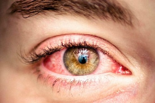 What Is Pink Eye?