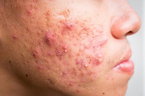 Prevents mild acne