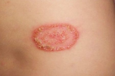 How To Get Rid Of Ringworm With Bleach ⋆ Bright Stuffs