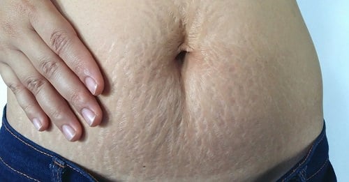 Stretch Marks Remedy