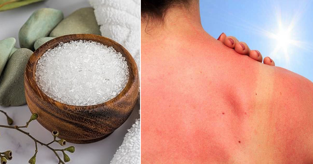 Does Epsom Salt Help Sunburn? Is Epsom Salt Good for Sunburn? ⋆