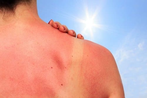 does epsom salt help with sunburn