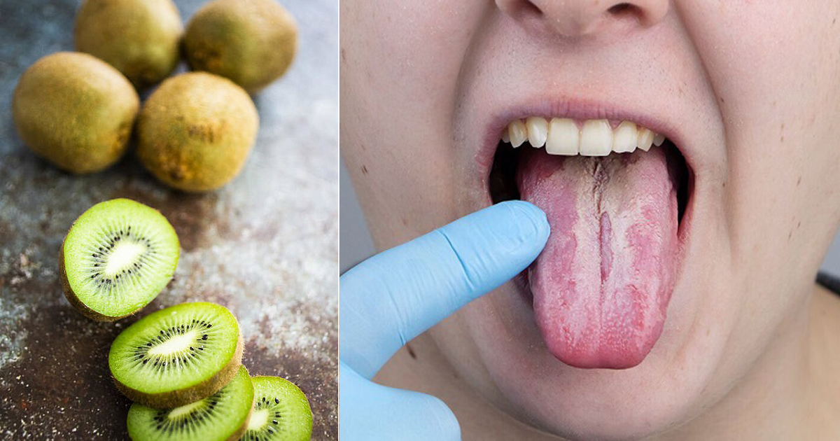 Why Do Kiwis Burn My Tongue? How To Stop Kiwi From Burning Tongue?